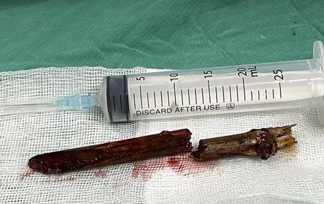 Phú Thọ: Cấp cứu thành công nam thanh niên bị đoạn tre đâm vào cổ