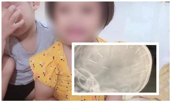Không phải 9, tất cả 10 chiếc đinh trong hộp sọ bé gái 3 tuổi