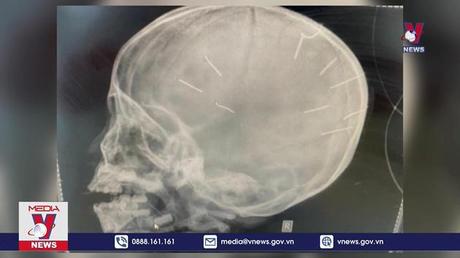 Công an lấy lời khai vụ bé 3 tuổi nghi bị đinh ghim ở đầu
