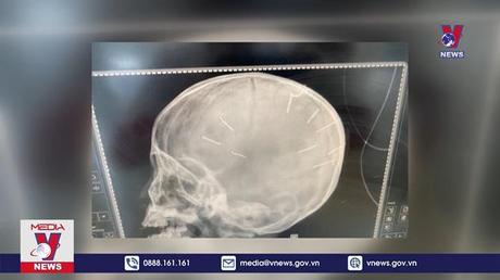 Cảnh sát hình sự tiếp nhận hồ sơ vụ bé gái 3 tuổi hôn mê