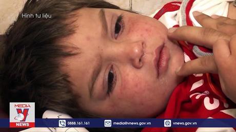 Bùng phát dịch sởi tại Afghanistan