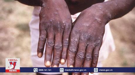 Thêm nhiều nước phát hiện các ca bệnh đậu mùa khỉ