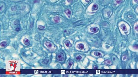 WHO họp khẩn về bệnh đậu mùa khỉ