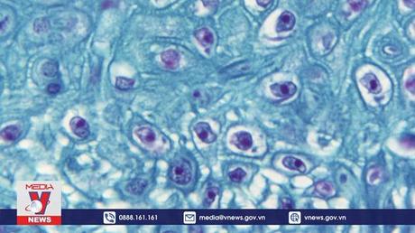 Bệnh đậu mùa khỉ xuất hiện tại nhiều nước