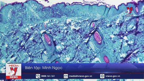 WHO đánh giá nguy cơ lây nhiễm bệnh đậu mùa khỉ