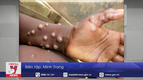 Mỹ đưa ra cảnh báo mới về bệnh đậu mùa khỉ