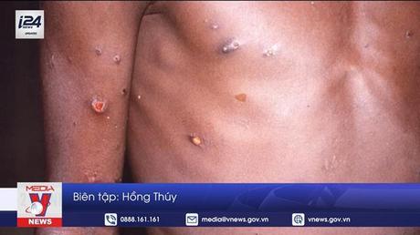 Israel phát hiện thêm một ca bệnh đậu mùa khỉ