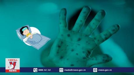 Cảnh báo nhiễm độc thần kinh do tay chân miệng