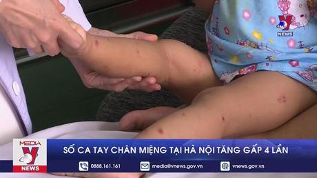 Số ca tay chân miệng tại Hà Nội tăng gấp 4 lần