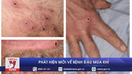 Phát hiện mới về bệnh đậu mùa khỉ