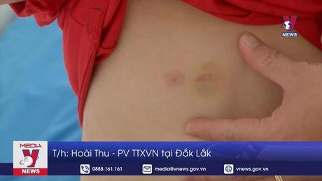 Đắk Lắk điều tra vụ việc cháu bé 9 tuổi bị đánh đập, nhiều vết thương tích 