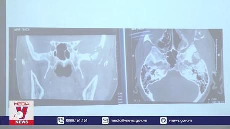 Bộ Y tế yêu cầu làm rõ nguyên nhân gây bệnh hoại tử xương hàm mặt