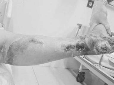 Nữ bệnh nhân phải cắt cụt chân vì biến chứng của đái tháo đường