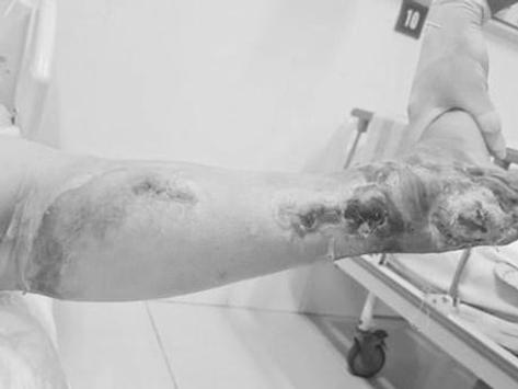 Nữ bệnh nhân phải cắt cụt chân vì biến chứng của đái tháo đường