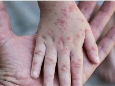 Bộ Y tế: Việt Nam hiện chưa ghi nhận trường hợp mắc đậu mùa khỉ