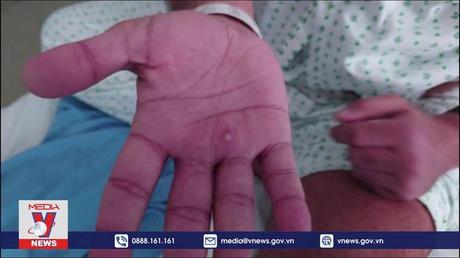 Kêu gọi WHO đổi tên virus bệnh đậu mùa khỉ