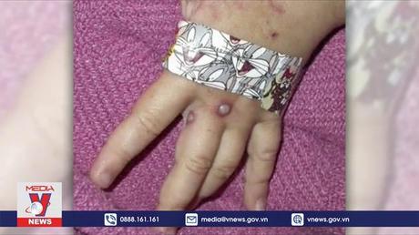 Số ca bệnh đậu mùa khỉ ở Australia tăng mạnh