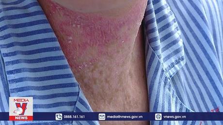 Cảnh báo biến chứng sau làm đẹp tại spa