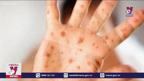 Bệnh sởi - nguy cơ đe dọa toàn cầu