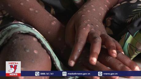 WHO sử dụng tên tiếng Anh mới cho bệnh đậu mùa khỉ