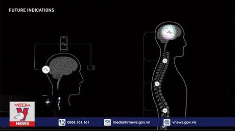 Neuralink sớm thử nghiệm gắn chip não trên người