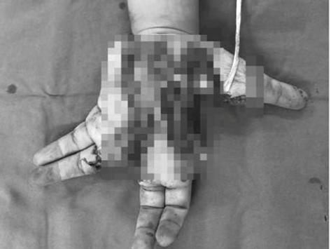 Một thiếu niên bị nát bàn tay trái do điện thoại nổ khi đang sử dụng