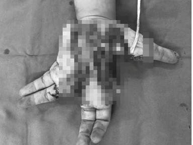 Một thiếu niên bị nát bàn tay trái do điện thoại nổ khi đang sử dụng