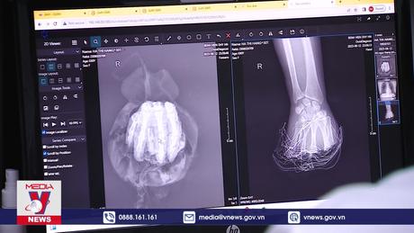 Kỳ tích tạo hình gân gấp 2 ngón chân thành ngón tay