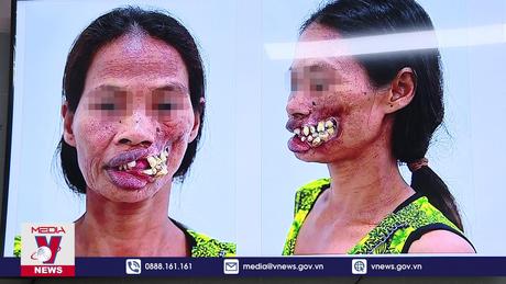 Tái sinh khuôn mặt cho người mắc bệnh hiếm gặp