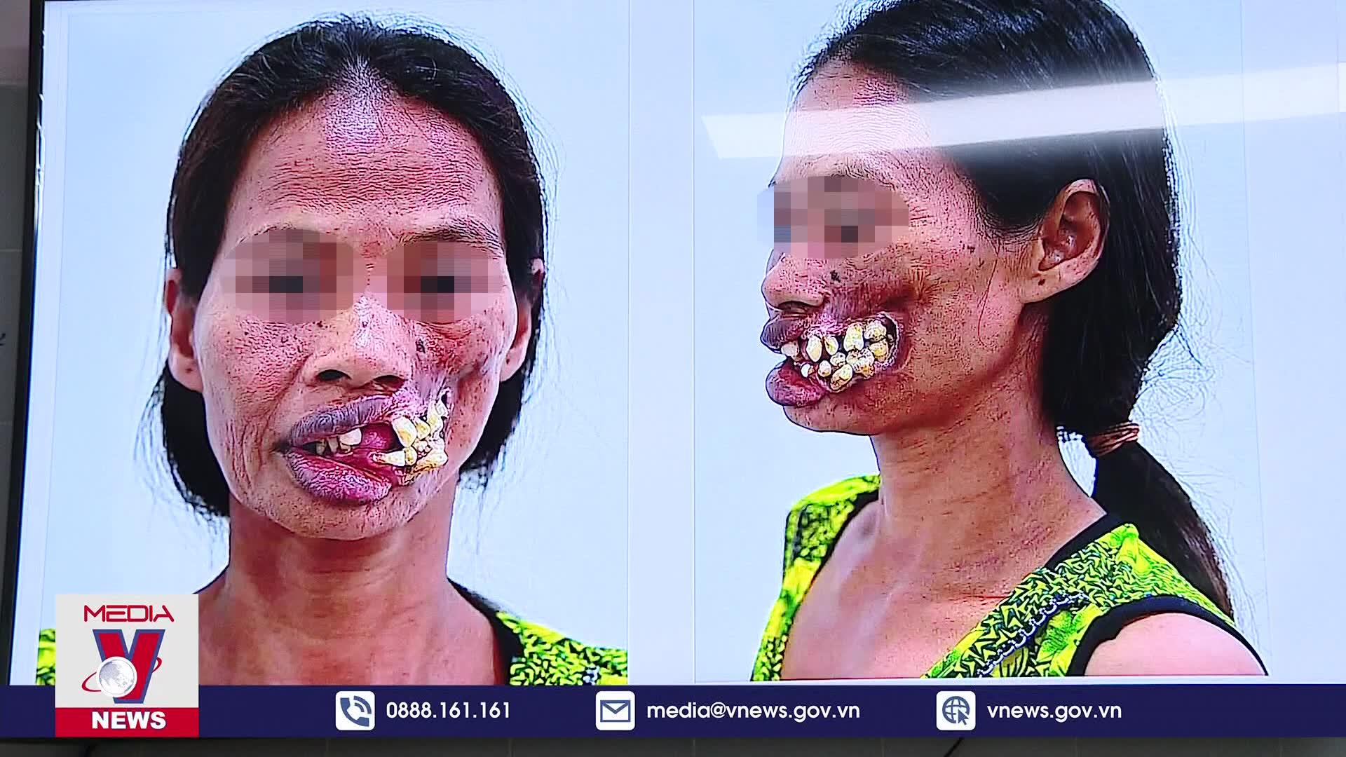 Tái sinh khuôn mặt cho người mắc bệnh hiếm gặp