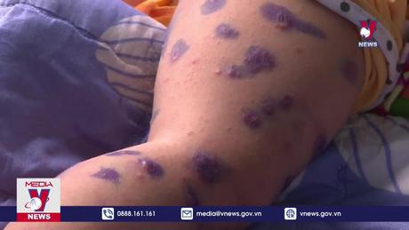 Không thiếu thuốc điều trị tay chân miệng 