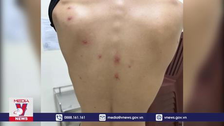 Việt Nam có ca tử vong đầu tiên liên quan đậu mùa khỉ