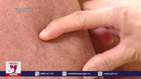 Dịch sốt xuất huyết diễn biến phức tạp