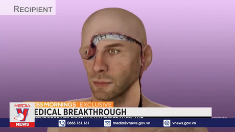 Ca ghép toàn bộ mắt đầu tiên trên thế giới