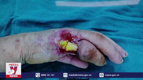 Hồi sinh bàn tay bị hoại tử do điện giật