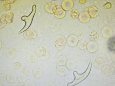 Người đàn ông nhiễm ấu trùng sán dây chó ký sinh tại phổi