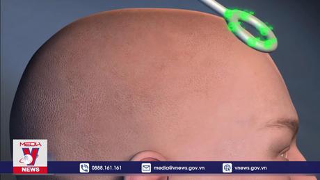 Cấy máy vào não để điều trị trầm cảm