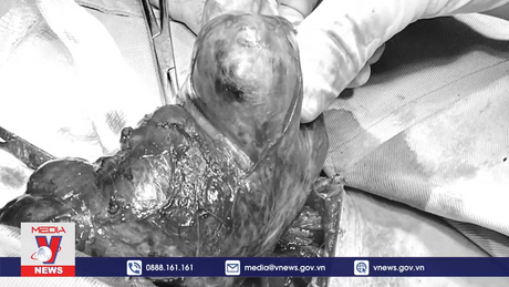 Phẫu thuật cắt bướu giáp khổng lồ cho bệnh nhân 50 tuổi