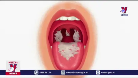 Bạch hầu – bệnh truyền nhiễm nguy hiểm 