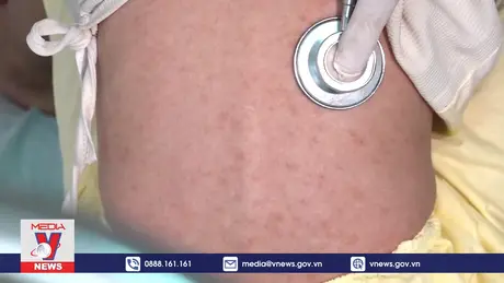 Đắk Lắk tăng cường phòng, kiểm soát dịch sởi lây lan