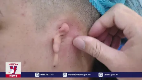 Lần đầu tiên tái tạo vành tai cho bệnh nhân dị tật bẩm sinh