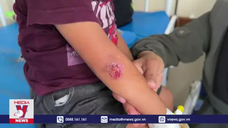 Bệnh ngoài da lây lan ở trẻ em tại Gaza