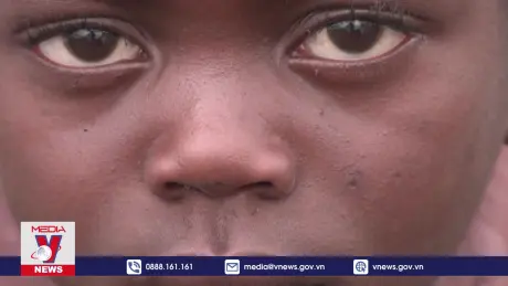 WHO triệu tập cuộc họp khẩn về bệnh đậu mùa khỉ