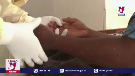 WHO ban bố tình trạng khẩn cấp về sức khỏe vì đậu mùa khỉ