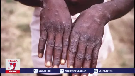 Phát hiện ca mắc bệnh đậu mùa khỉ đầu tiên bên ngoài châu Phi