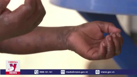 Các nước tăng cường ứng phó bệnh đậu mùa khỉ