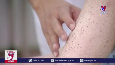 Gần 53.000 ca mắc sốt xuất huyết trên cả nước