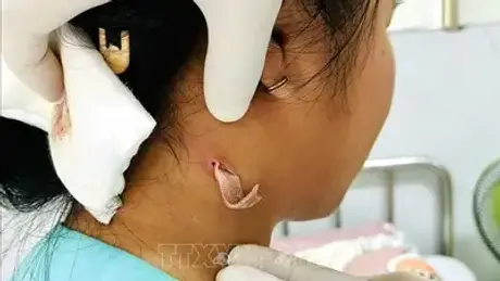 Đồng Nai ghi nhận ca bệnh từ vi khuẩn Whitmore đầu tiên