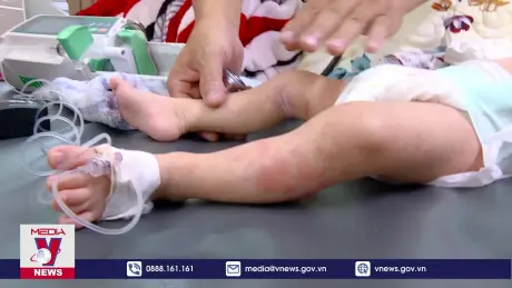 Bệnh viện quá tải vì số ca mắc sởi tăng cao