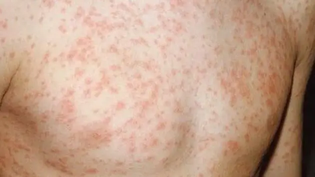 Hà Nội: Dự báo số ca mắc sởi gia tăng vào dịp Tết Nguyên đán